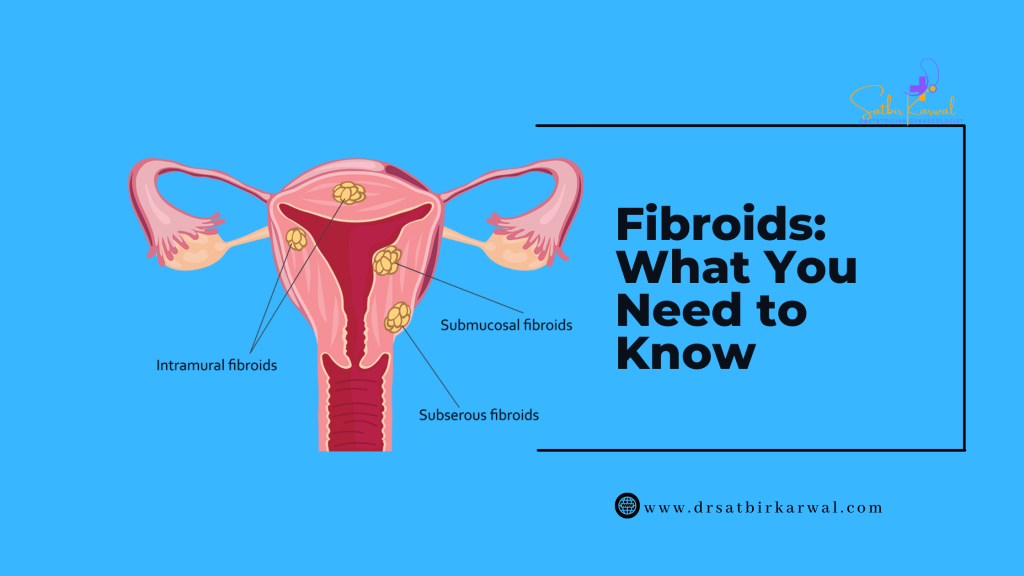 Fibroids: What You Need to Know